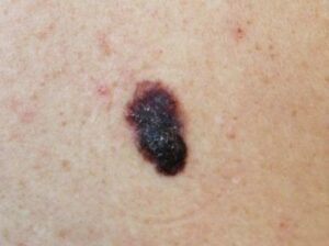 A picture of an asymmetrical mole, a sign of melanoma