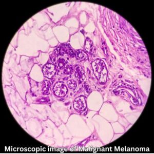 A microscopic photo of malignant melanoma